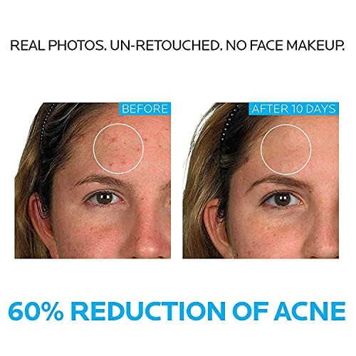 Comparison of acne reduction before and after 10 days.