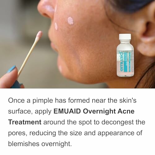 Person applying acne treatment with cotton swab.