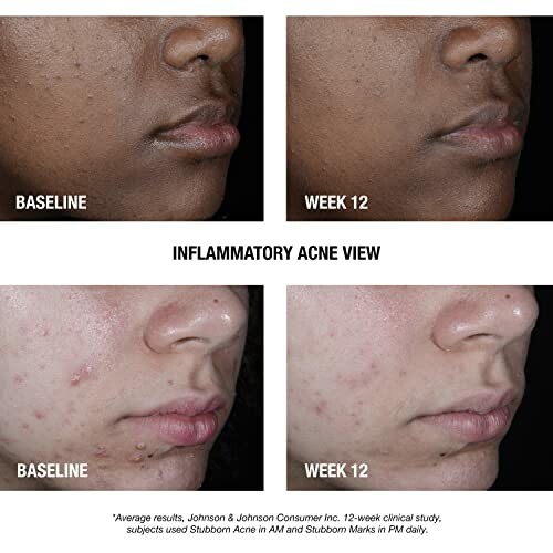 Before and after images showing acne treatment progress over 12 weeks.