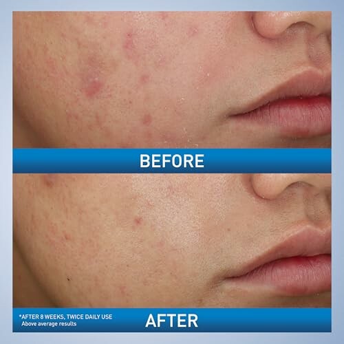 Comparison of skin before and after treatment, showing reduced acne and smoother texture.